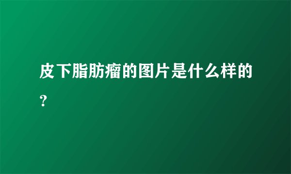 皮下脂肪瘤的图片是什么样的？