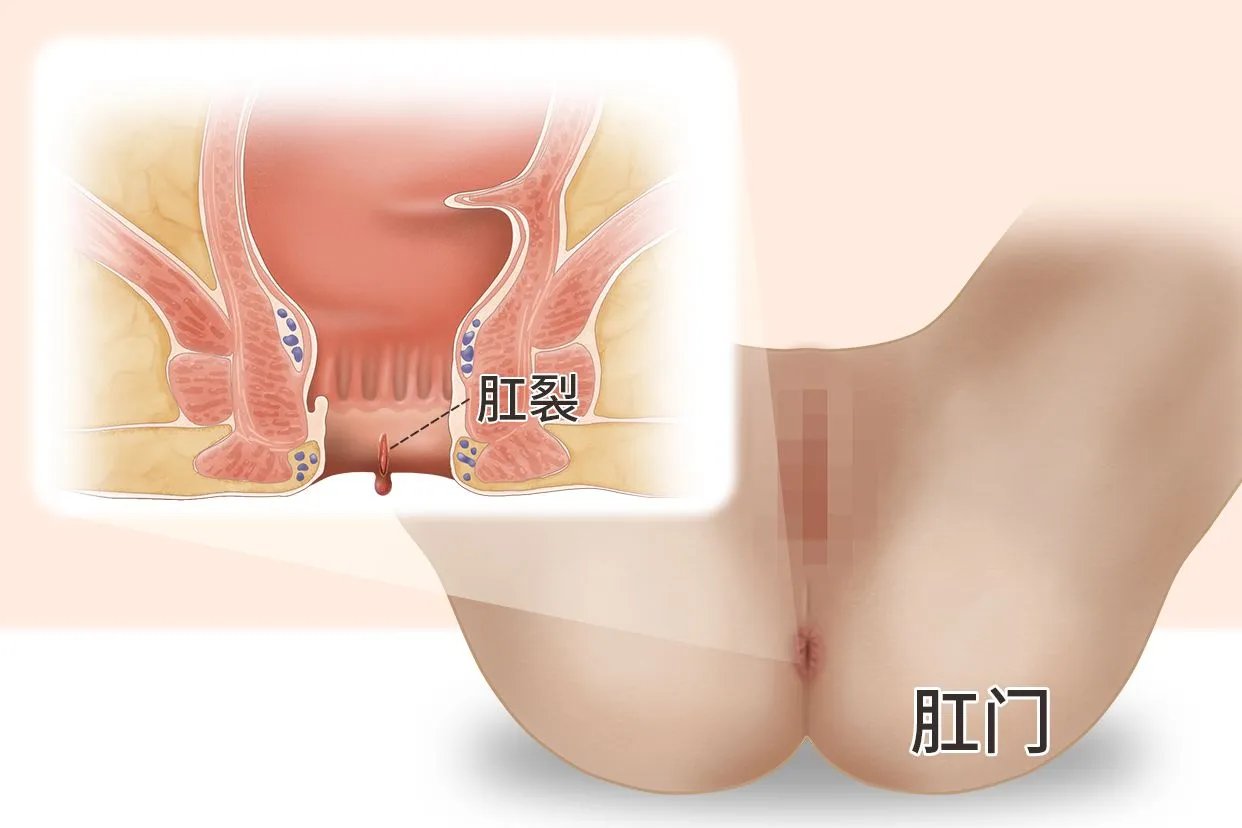 正常肛门和肛裂图片