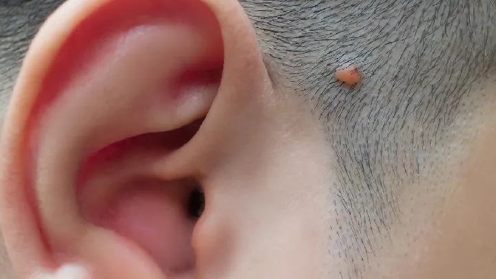 痤疮的治疗