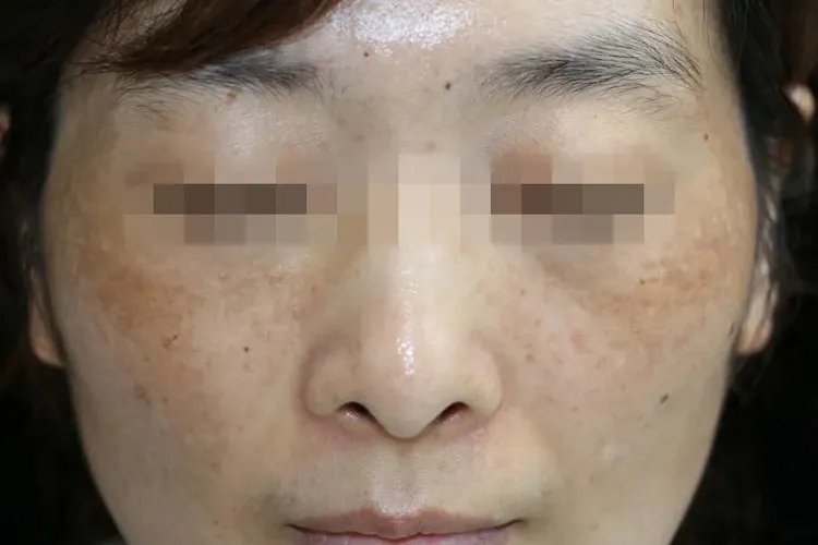 黄褐斑与晒斑最直观区别图片