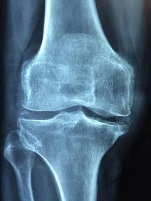 炎症的四个病理阶段是怎么样的 介绍炎症反应的相关知识