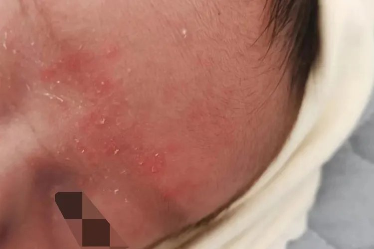 小孩身上痱子和湿疹的图片