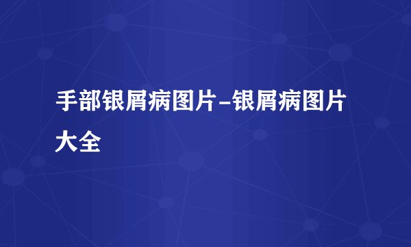 手部银屑病图片-银屑病图片大全