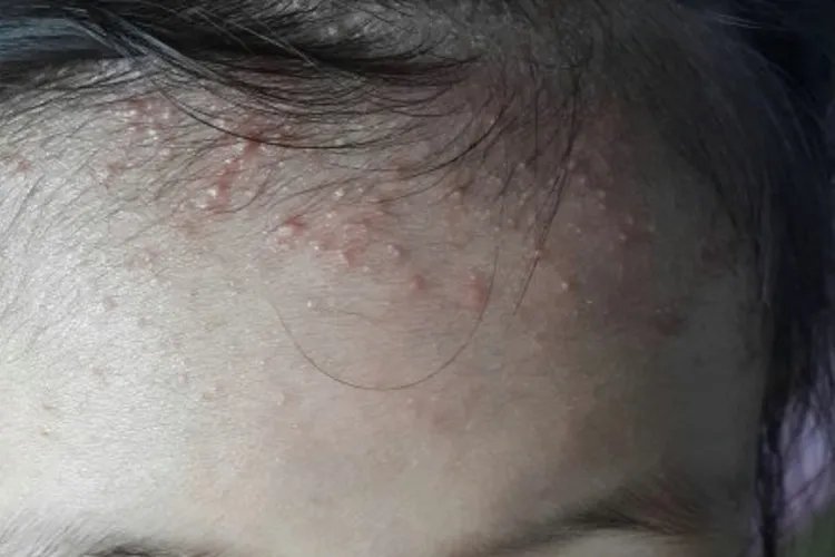 小孩身上痱子和湿疹的图片