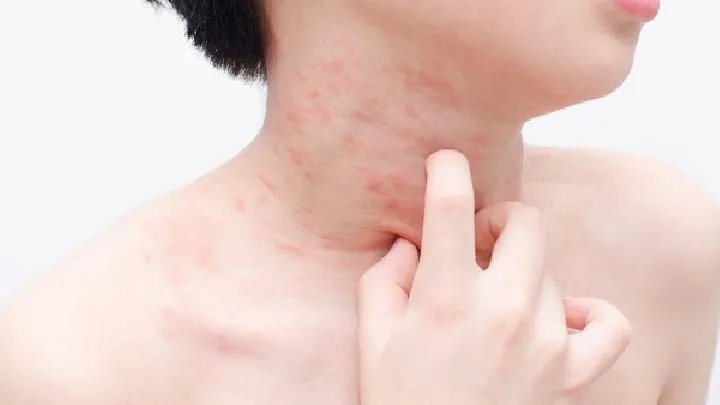 怎样选对扁平苔癣的医院呢