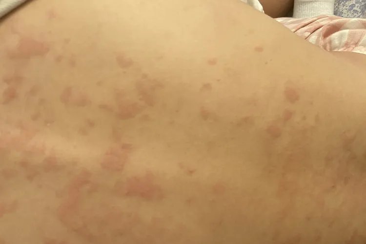 斑丘疹图片