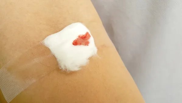伤口感染化脓怎么办