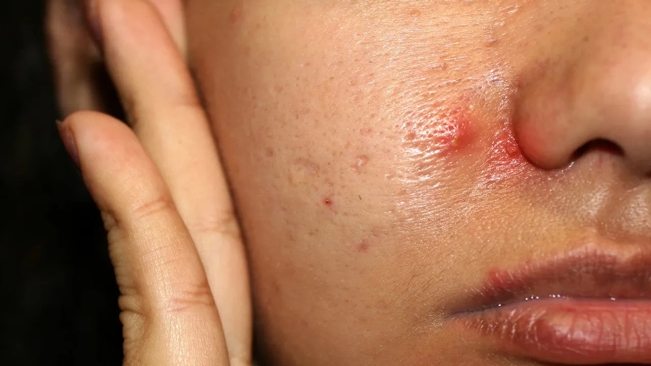 如何去粉刺