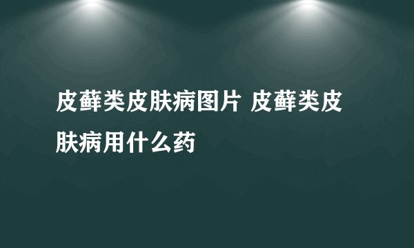 皮藓类皮肤病图片 皮藓类皮肤病用什么药