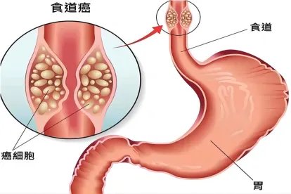 食道癌位置图片大全