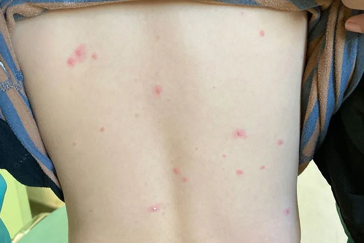 皮肤病真实照片大全