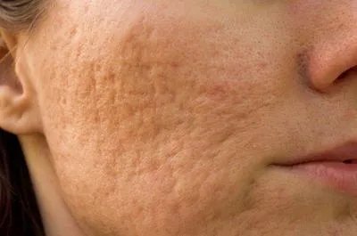 点痣留下疤痕怎么办 简单三步处理点痣疤痕