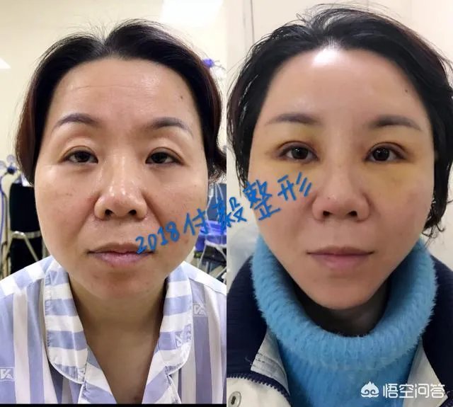 上睑下垂矫正术一定要做双眼皮吗