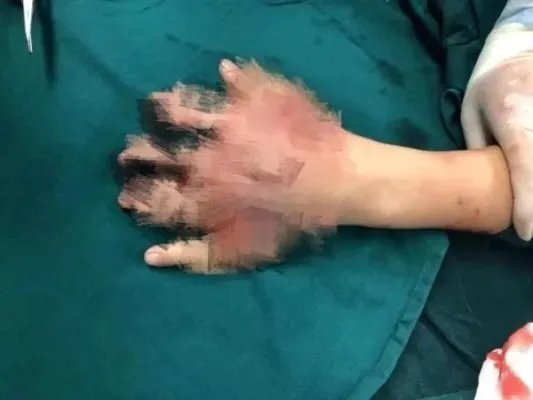 12岁男孩初一玩鞭炮左手5指全断，事情的起因是什么？