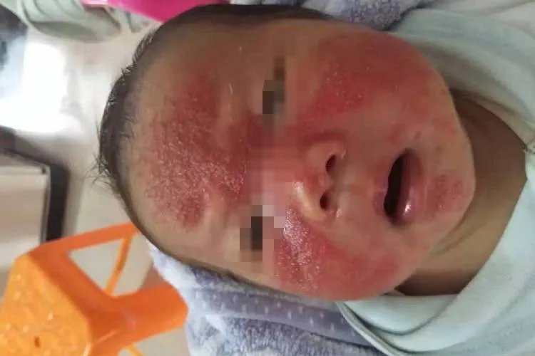 脂溢性皮炎的症状图片