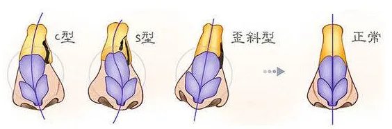 做鼻骨矫正大概需要多少钱?