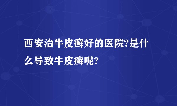 西安治牛皮癣好的医院?是什么导致牛皮癣呢?