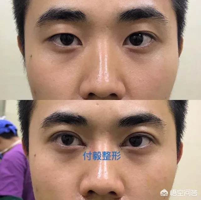 上睑下垂矫正术一定要做双眼皮吗