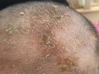 皮肤垢着病症状图片