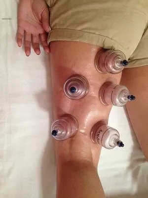 真空拔罐器好处和坏处介绍