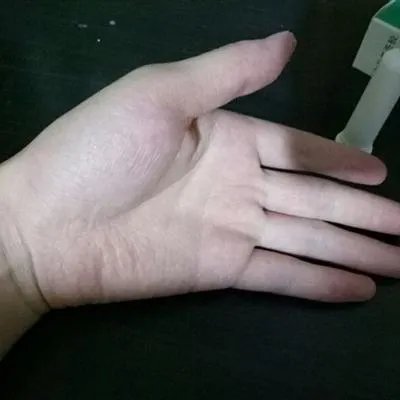 艾叶怎么治疗湿疹
