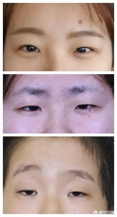 上睑下垂矫正术一定要做双眼皮吗