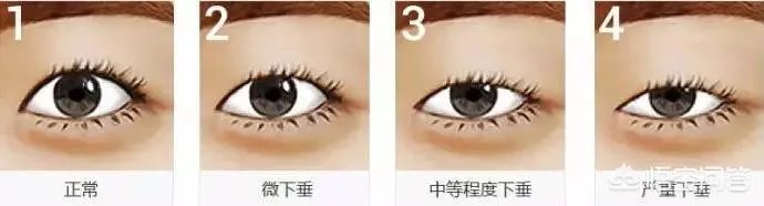 上睑下垂矫正术一定要做双眼皮吗