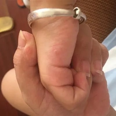 艾叶怎么治疗湿疹