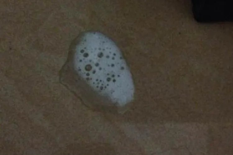 肺结核白色泡沫痰图片