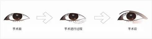 开眼角手术价格与什么相关?